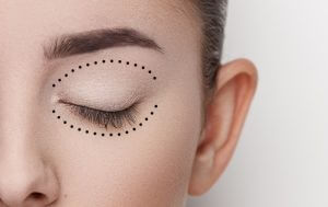 Cui i se adreseaza blefaroplastia?