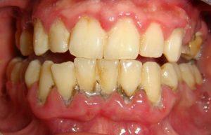 Ce este parodontica?