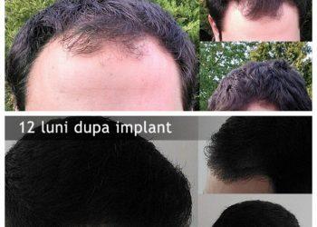 Implantul de par este solutia lipsei de par – afla despre procedura aceasta realizata la Dr. Felix Hair Implant