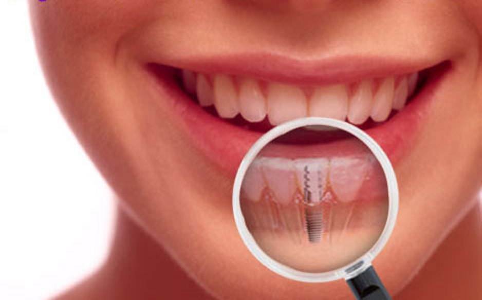 Cum sa-ti pastrezi in conditii optime implantul dentar?