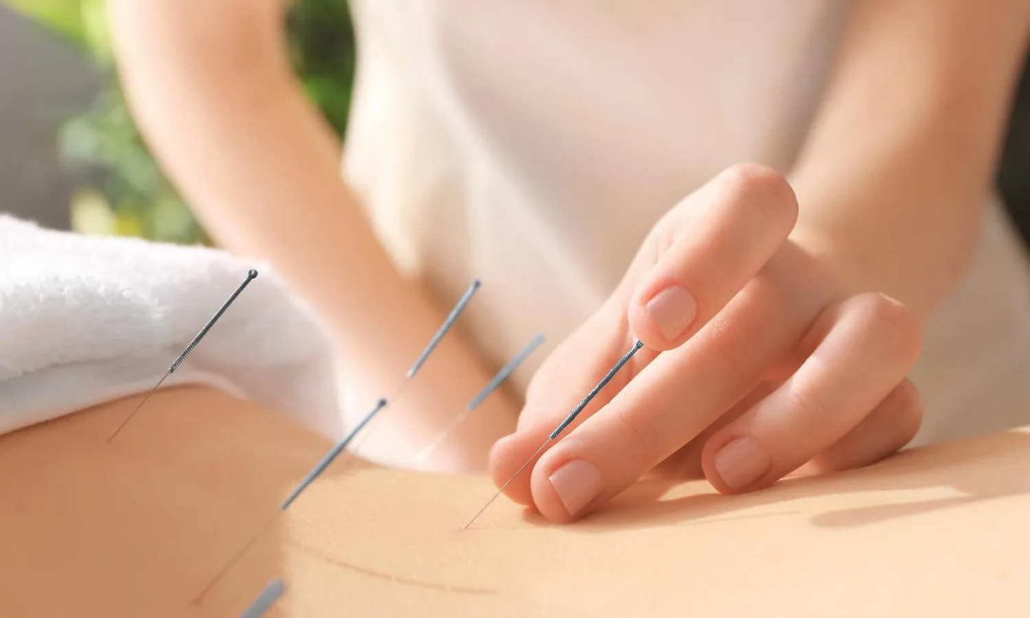 Acupunctura: pregătirea pentru o experiență benefică