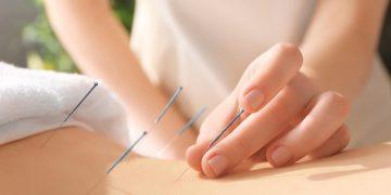Acupunctura: pregătirea pentru o experiență benefică