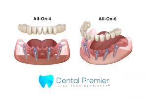 preturi-proteze-dentare-fixe-all-on-4-6-implanturi