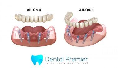 preturi-proteze-dentare-fixe-all-on-4-6-implanturi