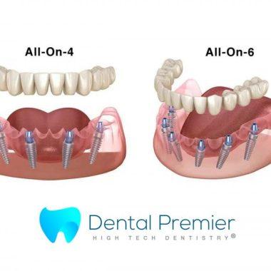 preturi-proteze-dentare-fixe-all-on-4-6-implanturi