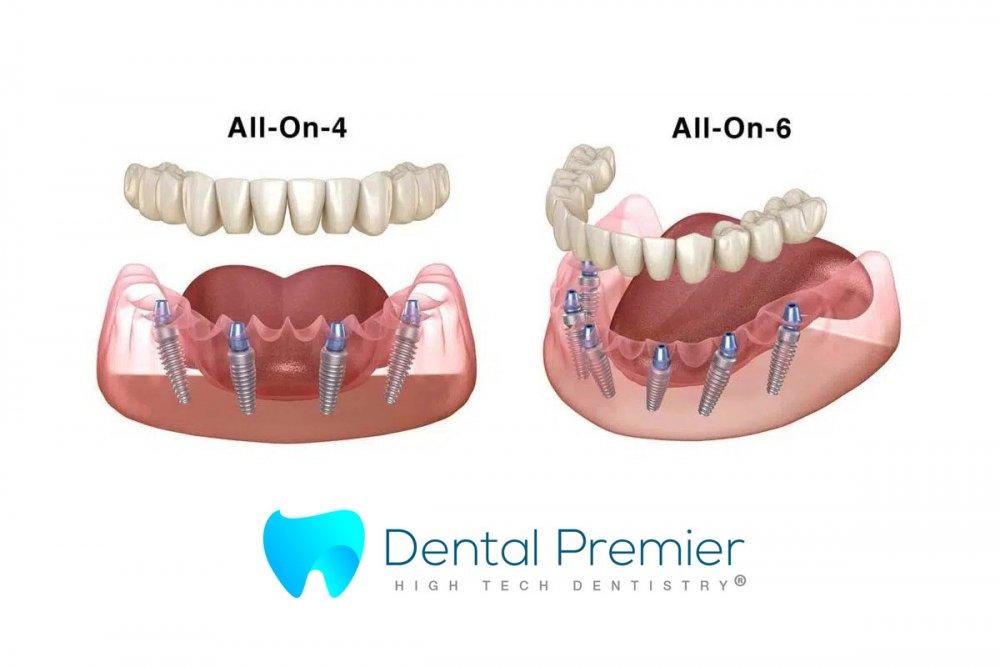 preturi-proteze-dentare-fixe-all-on-4-6-implanturi